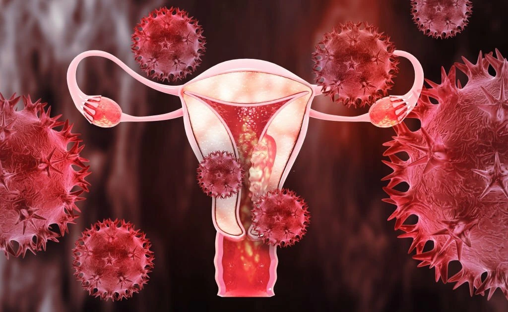 Endometrial cancer Treatment in Madurai at Guru hospital